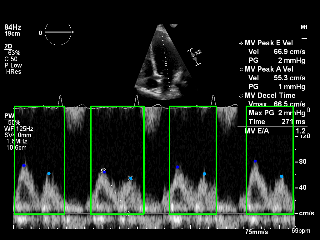 Mitral inflow example image